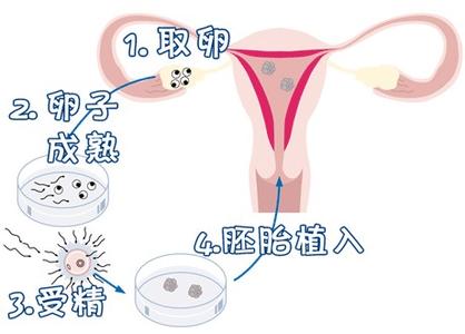 代生试管机构